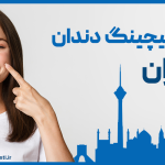 قیمت بلیچینگ دندان در تهران