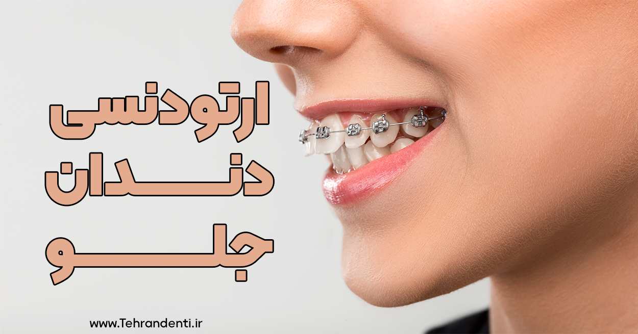 قیمت ارتودنسی دندان جلو در تهران
