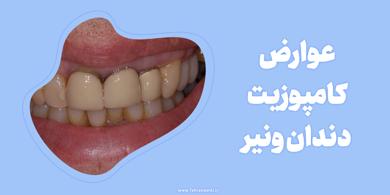 عوارض کامپوزیت دندان ونیر
