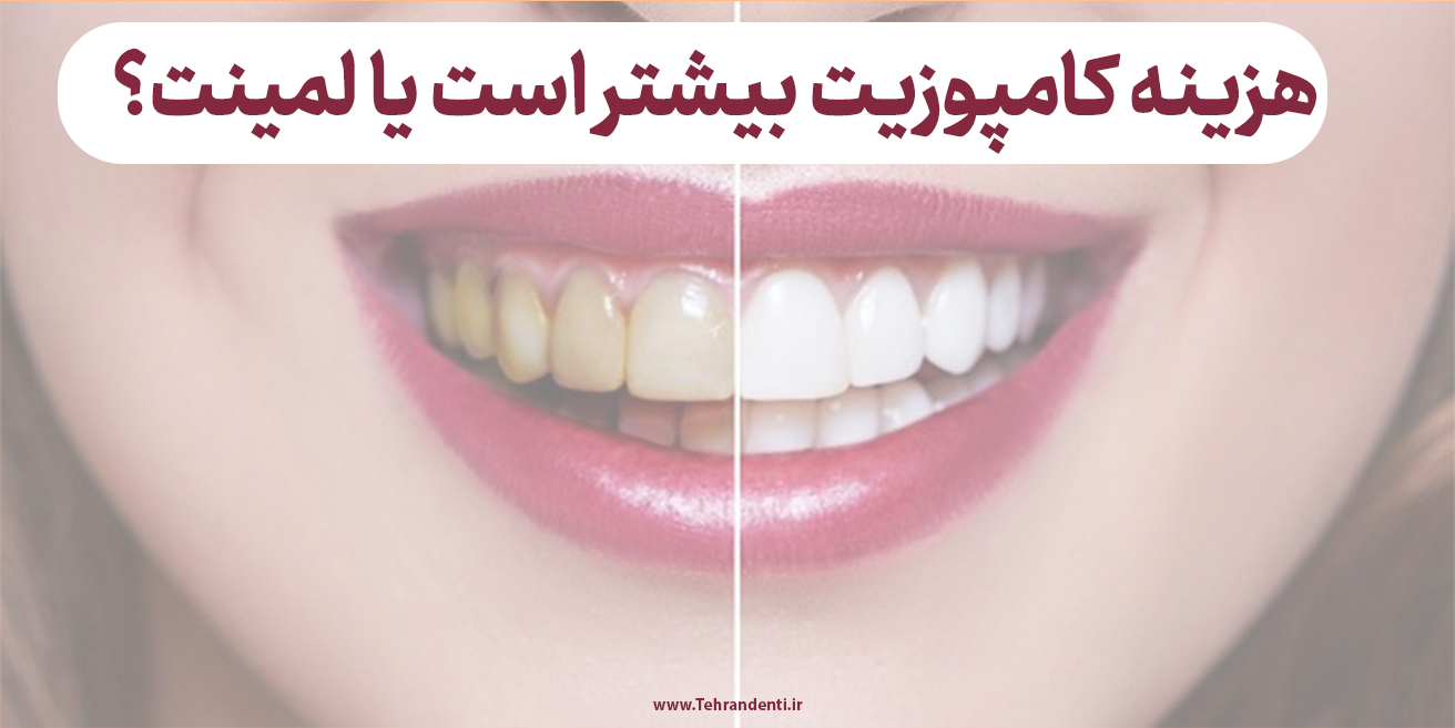 هزینه کامپوزیت بیشتر است یا لمینت؟