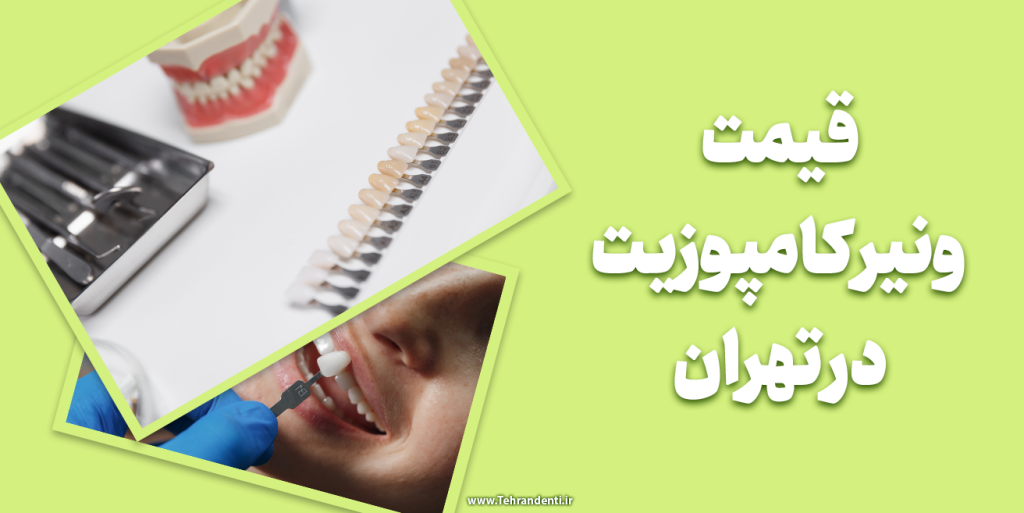 قیمت ونیر کامپوزیت در تهران