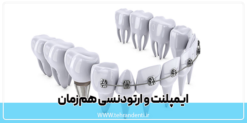 ایمپلنت و ارتودنسی هم‌زمان