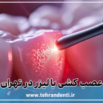 عصب کشی با لیزر در تهران