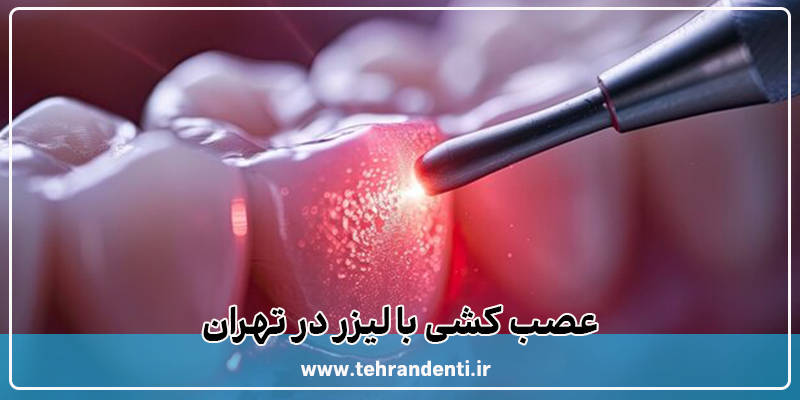 عصب کشی با لیزر در تهران